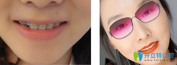 成都極光口腔自鎖陶瓷托槽正畸效果好不好