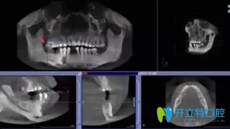 種植牙過程分為幾個(gè)步驟?看完這幾張圖解就知道種牙不痛苦