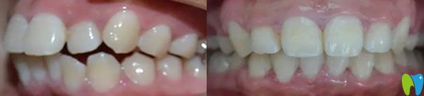 齙牙矯正前后效果對比圖 齙牙矯正前后效果對比圖