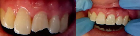 門牙斷裂怎么辦及修復方法 大連美麗雅口腔聞院長詳細解答