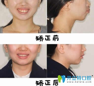 昆明尚愛韓美口腔申晶院長隱形牙齒矯正案例圖