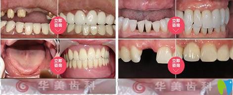 <!--<i data=20240703-sp></i>-->華美種植牙醫(yī)生<!--<i data=20240703-sp></i>-->牙齒種植案例圖