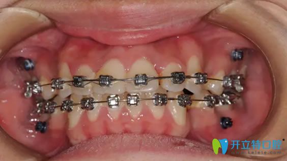 牙套的種類(lèi)之金屬牙齒矯正器