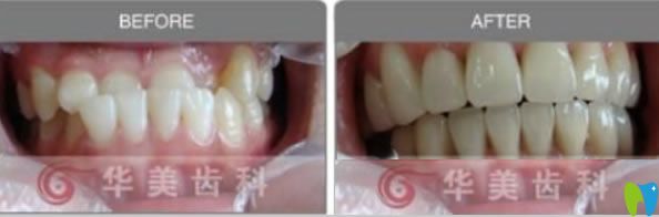 <!--<i data=20240703-sp></i>-->華美口腔<!--<i data=20240703-sp></i>-->地包天矯正前后對比案例