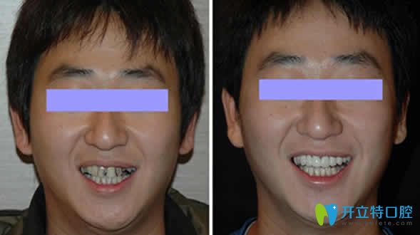 牙齒美容冠前后對比照片