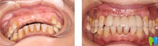 成都新橋口腔種牙前后效果對(duì)比