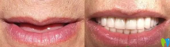 聞?dòng)钤洪L全口牙缺失即刻種植牙種植案例