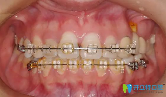 牙套的種類(lèi)之陶瓷托槽矯正器
