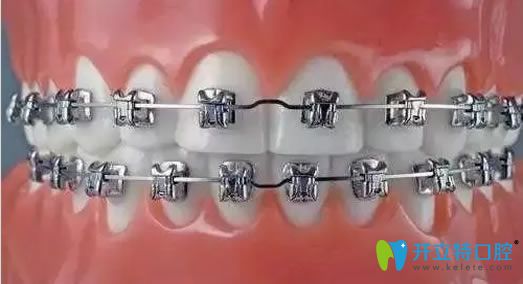 牙套的種類(lèi)之自鎖托槽矯正器