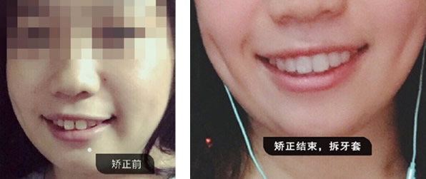 看到廣州德仁口腔正畸效果 朋友問我做隱形矯正牙齒多少錢