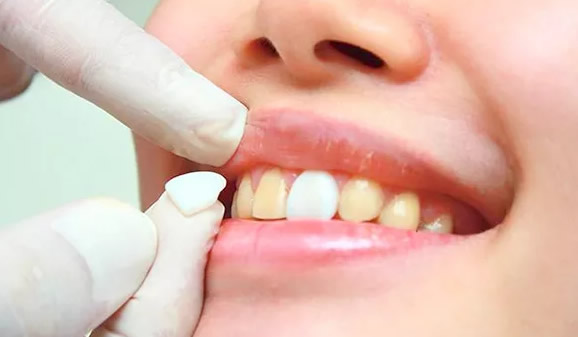 牙齒黃怎么辦 我們都想知道美白牙齒的方法及價格要多少錢