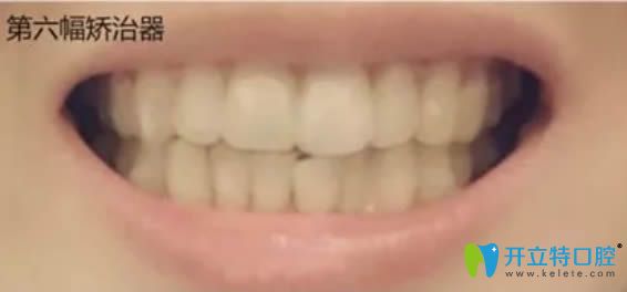 佩戴第6副隱形矯正器的照片