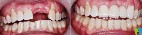 廣州德仁口腔種植牙效果案例