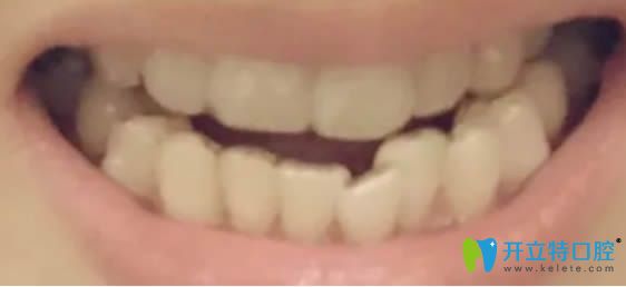 在<!--<i data=20240703-sp></i>-->華美口腔做牙齒矯正術(shù)前照