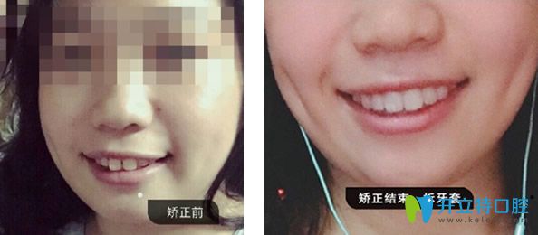 廣州德仁口腔隱適美隱形矯正牙齒效果案例