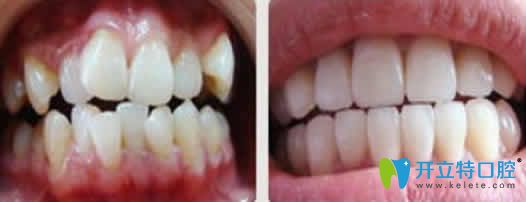 28歲矯正牙齒前后對(duì)比照片