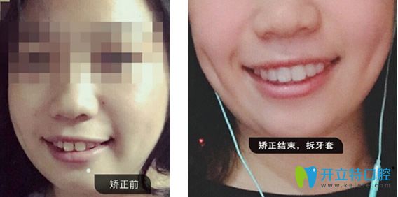 德仁口腔隱適美隱形矯正牙齒前后效果對比案例