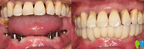 青島西諾德口腔半口牙種植前后對比圖