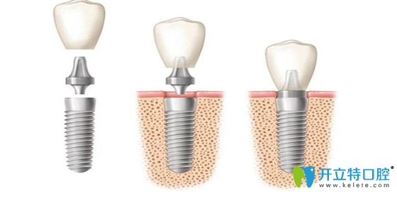 即刻種植牙好嗎？老年人能做即刻種植牙嗎？