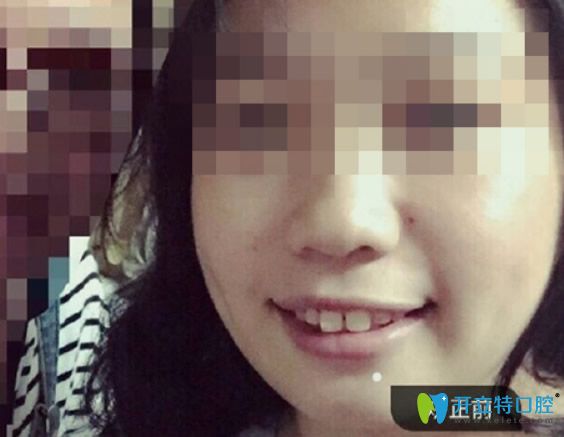 廣州德仁口腔隱適美隱形矯正牙齒前