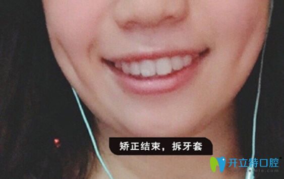 廣州德仁口腔隱形正畸14個月效果