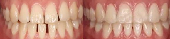 隱形矯正牙齒有用嗎 分享大連美麗雅口腔牙齒稀疏矯正經歷