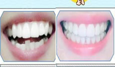 齙牙在廣州歐頓口腔做隱形矯正650天，來曬牙齒變化圖啦