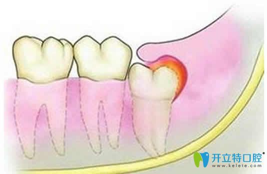 請問急性冠周炎怎么治療？提供全面的治療方法