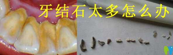 牙結石的形成原因及危害  并分享超聲波潔牙價格供你參考