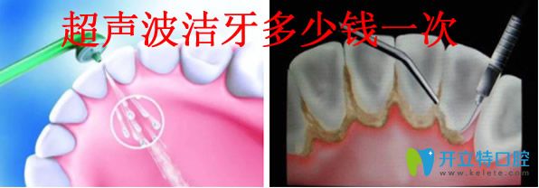 超聲波潔牙價格