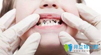 兒童齲齒的原因有哪些