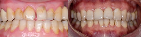 烤瓷牙牙齦萎縮能恢復(fù)嗎 大連沙醫(yī)生李爽詳述牙齦萎縮原因