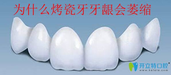 為什么做了烤瓷牙牙齦會萎縮