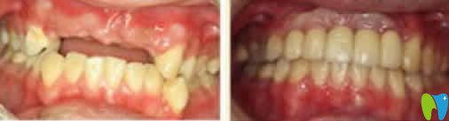 門牙缺失隱形義齒修復(fù)效果圖