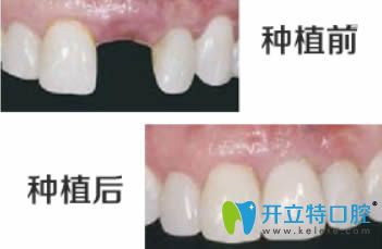開立特口腔種植牙前后對比圖