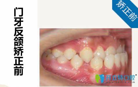 門牙反頜矯正前的照片