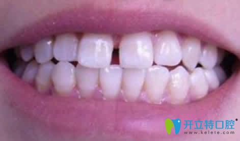 兩顆門牙中間有縫怎么辦能做矯正嗎？看資深牙醫(yī)詳解