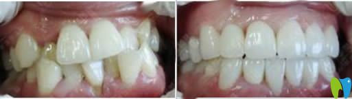 西安海濤口腔李永剛牙齒擁擠矯正案例