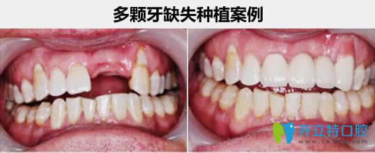汪文文醫(yī)生多顆牙缺失種植牙案例及前后對比照