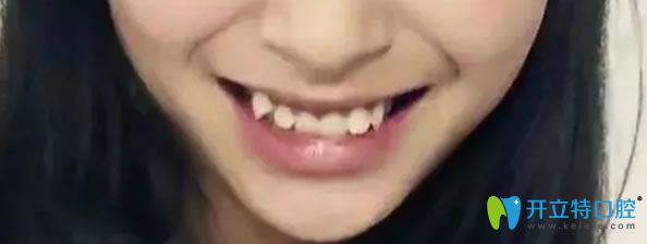 大連沙醫(yī)生口腔牙齒矯正前