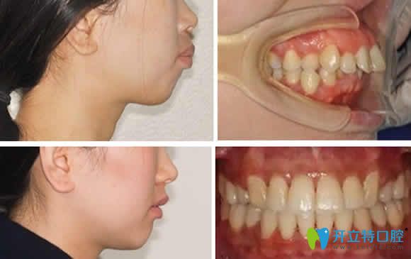 福州晶特爾口腔牙齒矯正案例效果