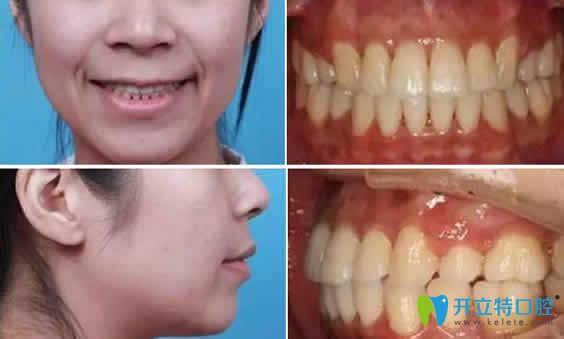 我在福州晶特爾齒科做隱形牙齒矯正一年半效果