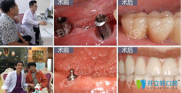 康貝佳口腔全口牙缺失種植修復效果