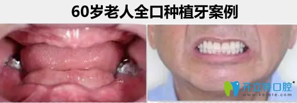 南昌維樂口腔汪文文種植牙