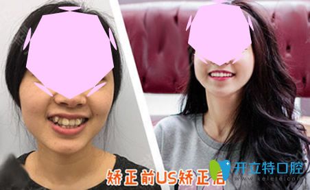 成都歡悅口腔隱形矯正術前術后對比案例