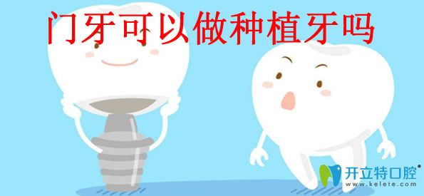 門牙缺失種植牙好不好 牙齒種植體品牌及價格的答案都在這