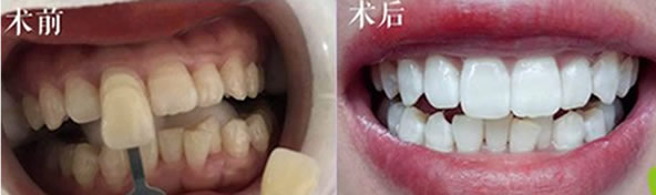 冷光美白對(duì)牙齒有危害嗎？關(guān)于為什么牙齒會(huì)變黃的小知識(shí)