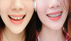 奉上我在成都?xì)g悅口腔戴鋼絲牙套1-4個(gè)月臉型變化圖及感受