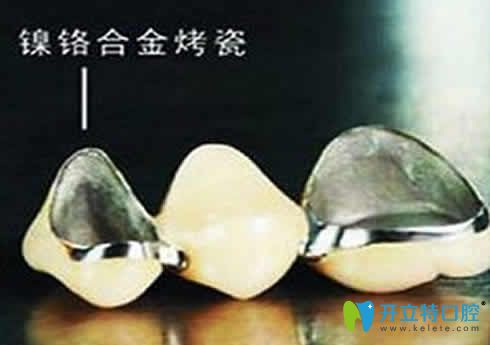 網(wǎng)上說鎳鉻烤瓷牙會(huì)致癌是真的嗎？揭秘鎳鉻烤瓷牙的危害