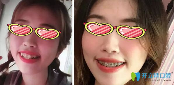 <!--<i data=20240703-sp></i>-->口腔傳統(tǒng)金屬托槽矯正牙齒前后效果對(duì)比圖